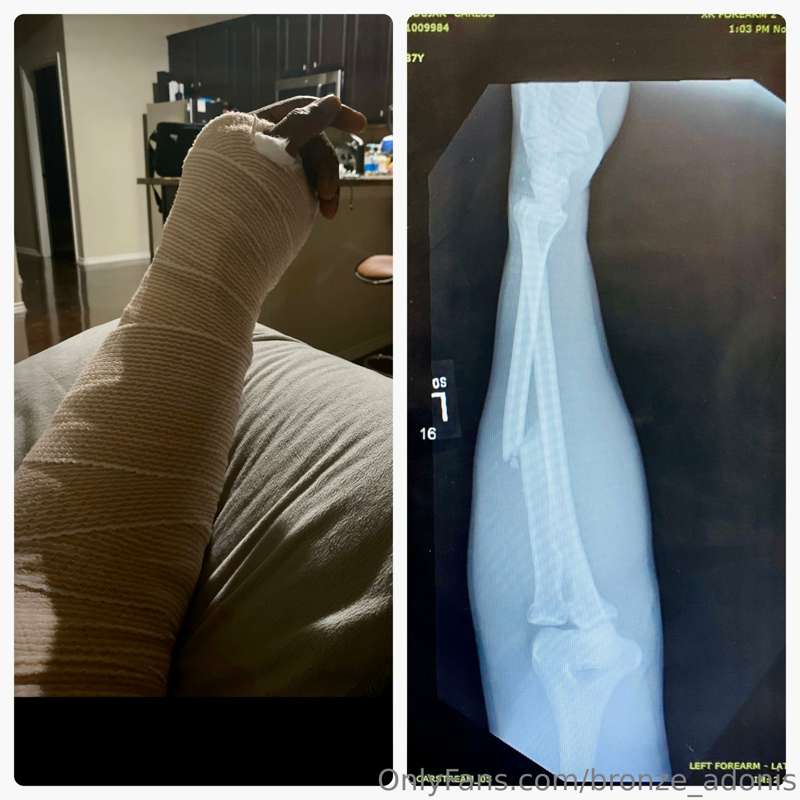 1 year ago I broke my left arm, and left wrist in an acciden.. 1