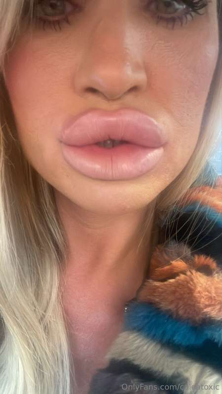 I have finally had my lips injected again. I love the feelin..