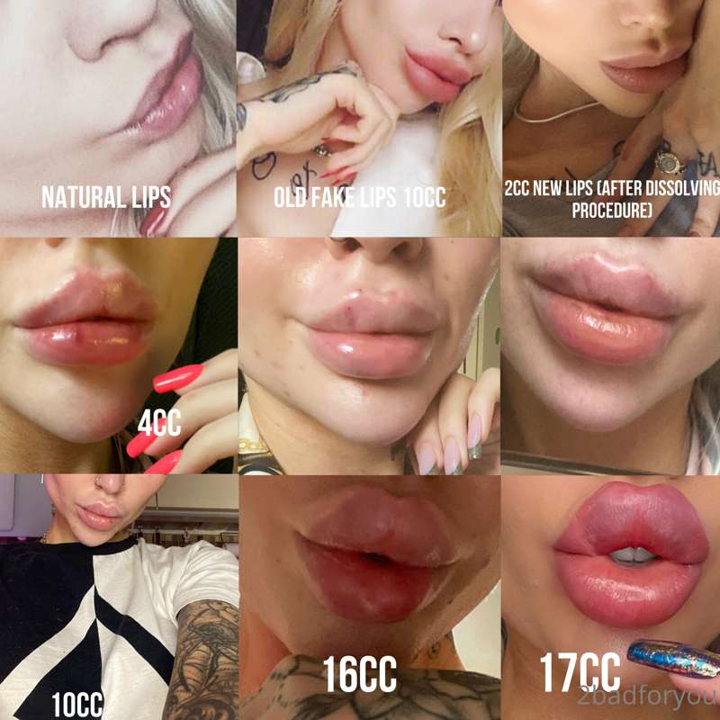 0cc - 10cc - 0cc - 17cc. 💉