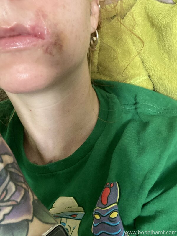 Mouth photo update. Current state vs first day
