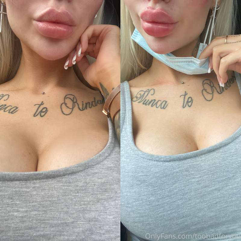 Before/ after. (Warning, swollen!!!!!)
those lips were made ..