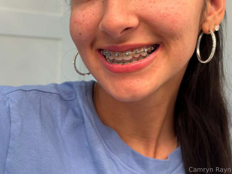 So many people requesting close ups of my braces so for anyo..