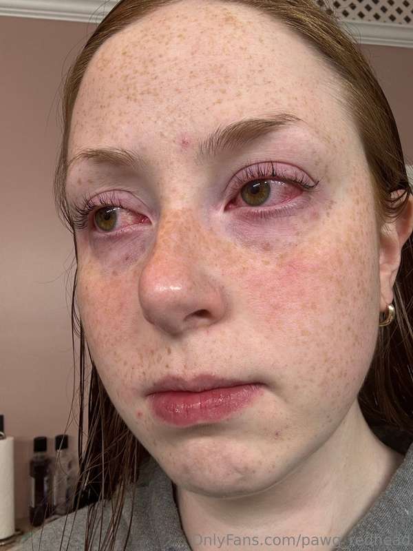 This is what happens when you let someone cum in your eyebal..