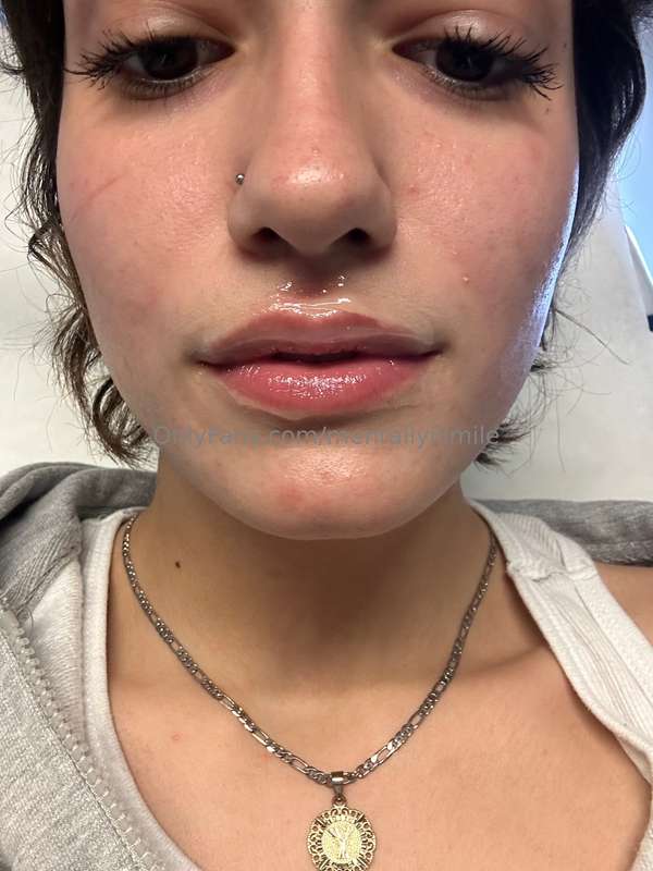 Guess who got some lip filler hehee