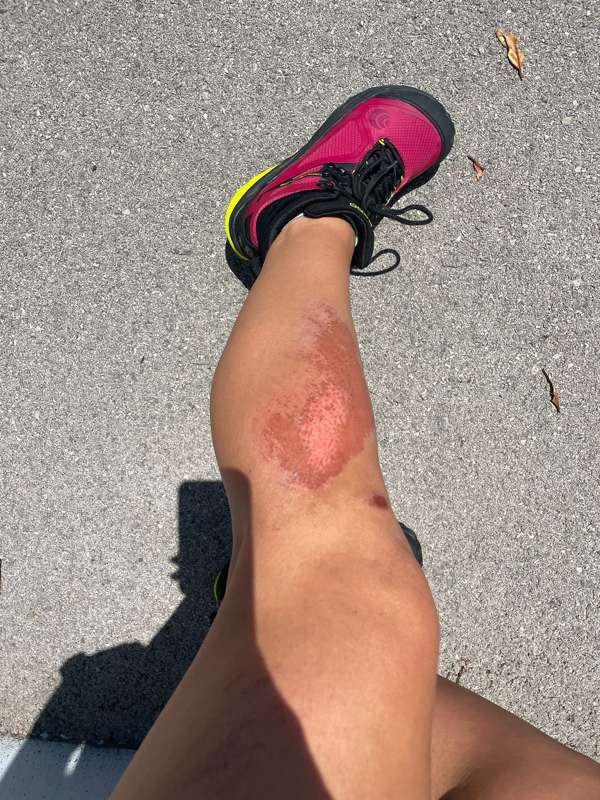 **NSFW** post-biking accident, ***who wants to take me to th.. 1