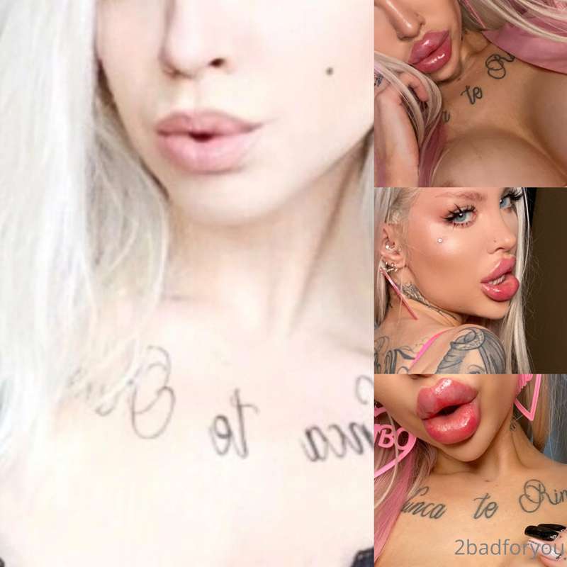 The fillers - this is the best thing i have ever done to mys..