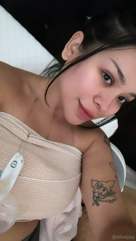Hi guys i got surgery for my capsular contracture and i did ..