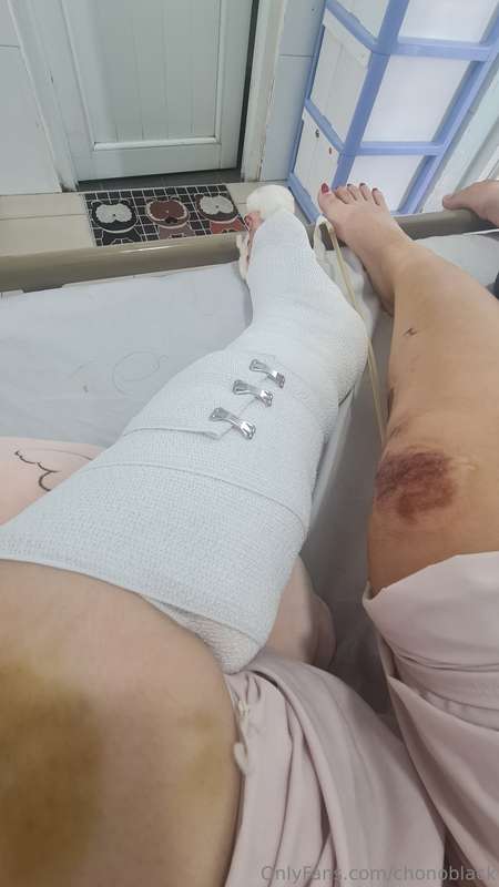 I was in a car accident, result in a wound on the back of my..