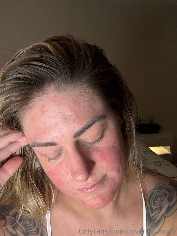 Ended up with this allergic reaction so I took some Benadryl..