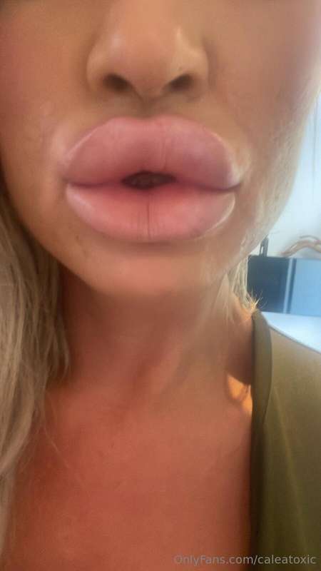 I have finally had my lips injected again. I love the feelin.. 2