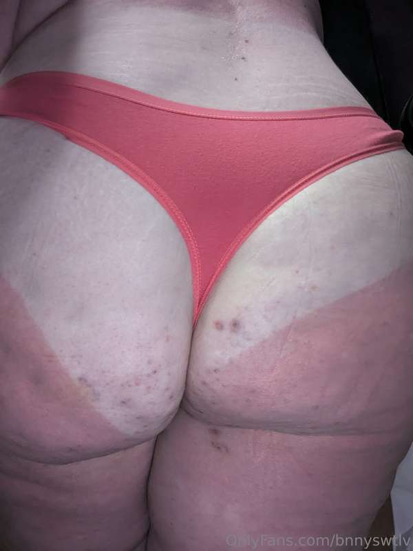 Sunburn sucks