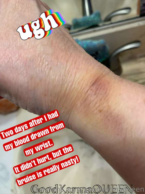 I'd rather it LOOK worse than it felt when she drew my blo*o..
