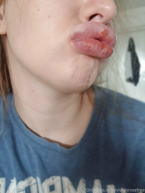 My lips straight after getting my latest fillers, when they ..