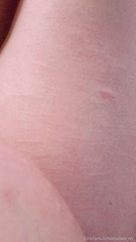 Tw. Self harm scars

.
 
. 

.


So these pics have angles, .. 2