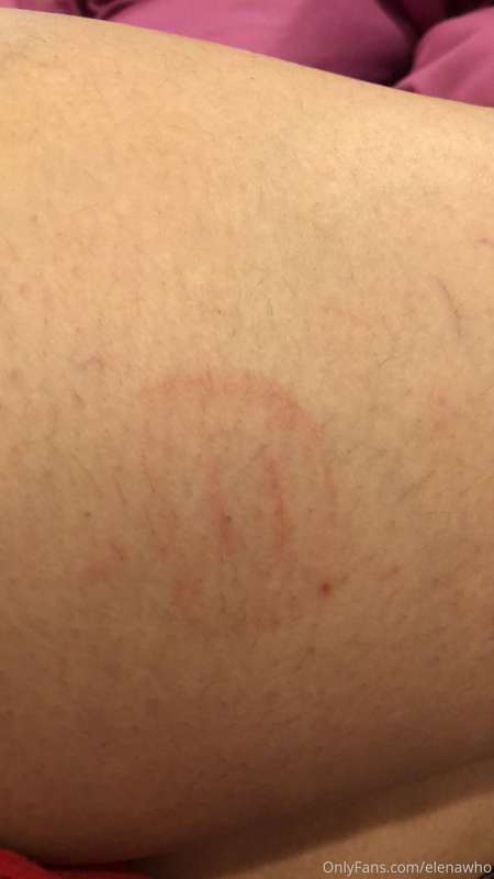 My marked booty after an intense impact scene and yes that’s..