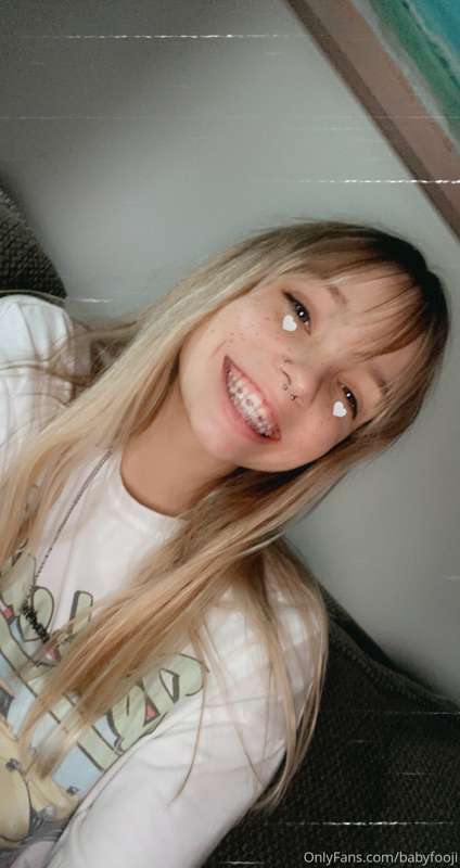 What do you think of my braces?!? ☺️ I’m so self conscious a..