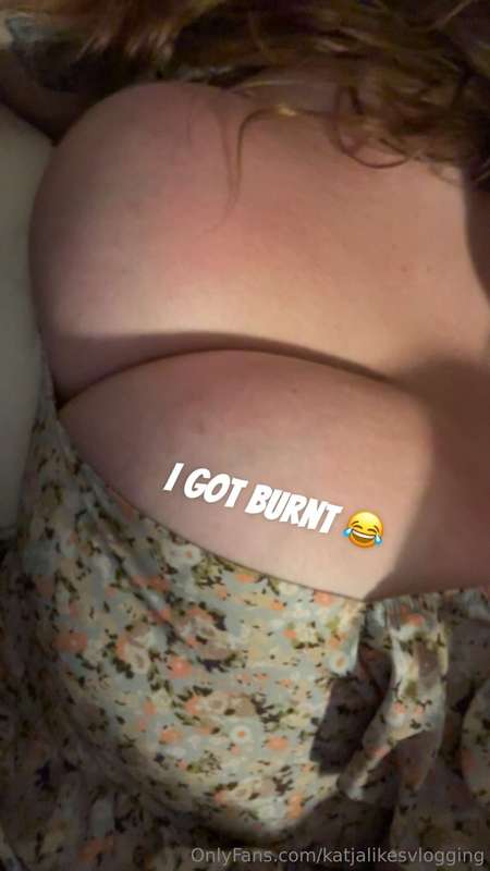 I got burnt in the park yesterday 😂😭