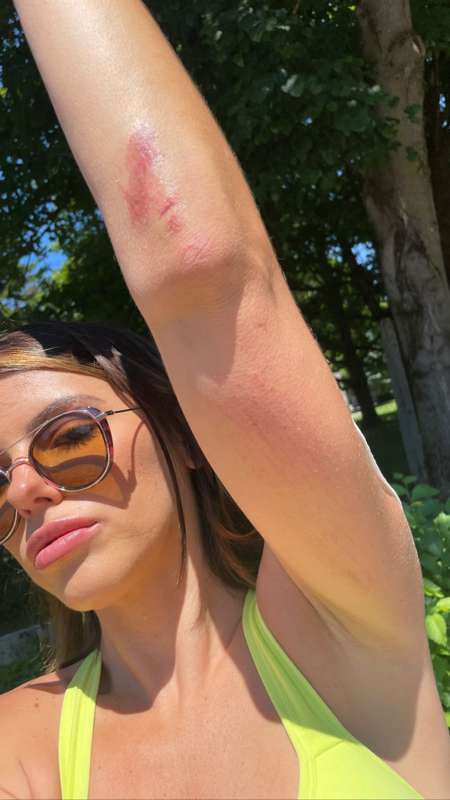 **NSFW** post-biking accident, ***who wants to take me to th..