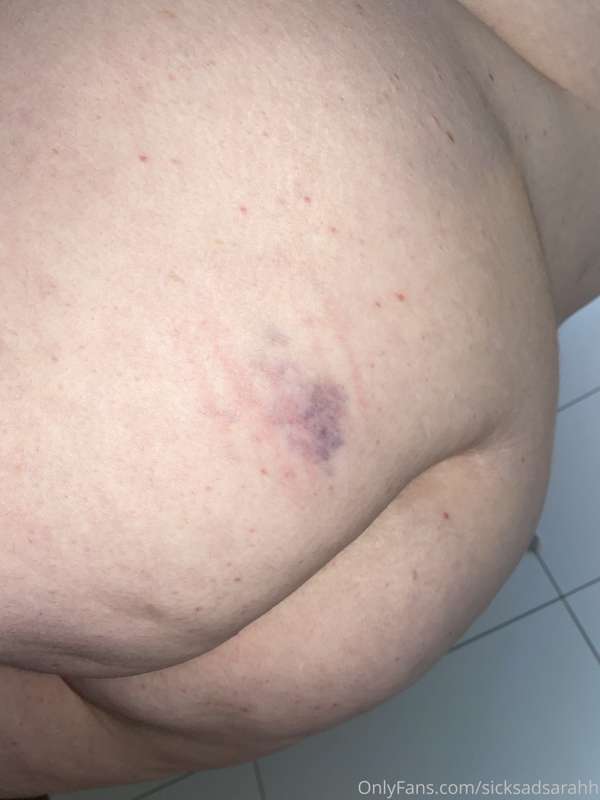 Booty bruises 😈🖤