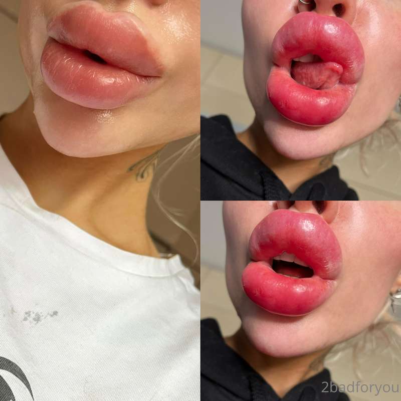 +1.💉
They hard as ur cock rn. Swollen. Fresh. Big. Firm. I l..