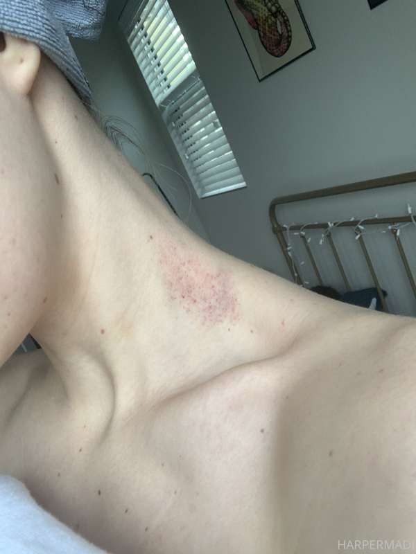 baby has a hickie