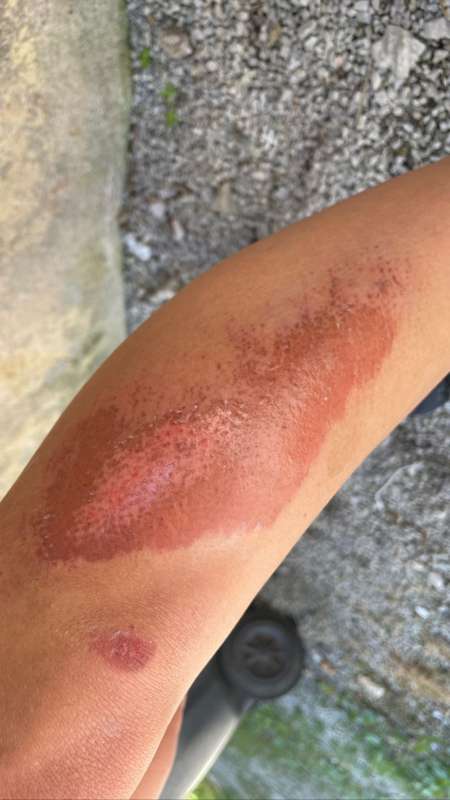 **NSFW** post-biking accident, ***who wants to take me to th.. 3