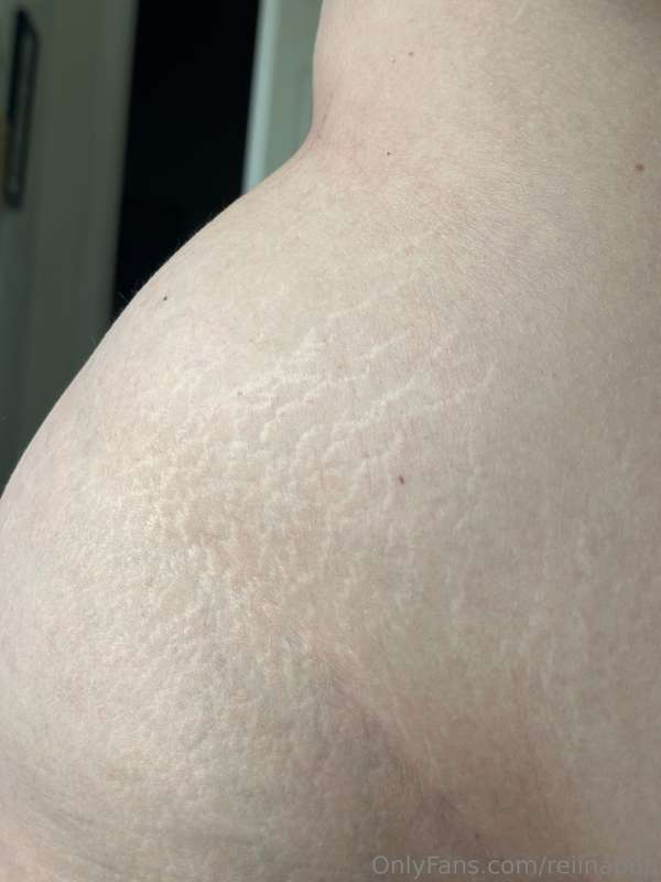 My stretch marks look so pretty in the sun!!! 😻 they’re only.. 1