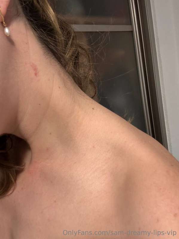 A fucking hickey!!! Siiiigh