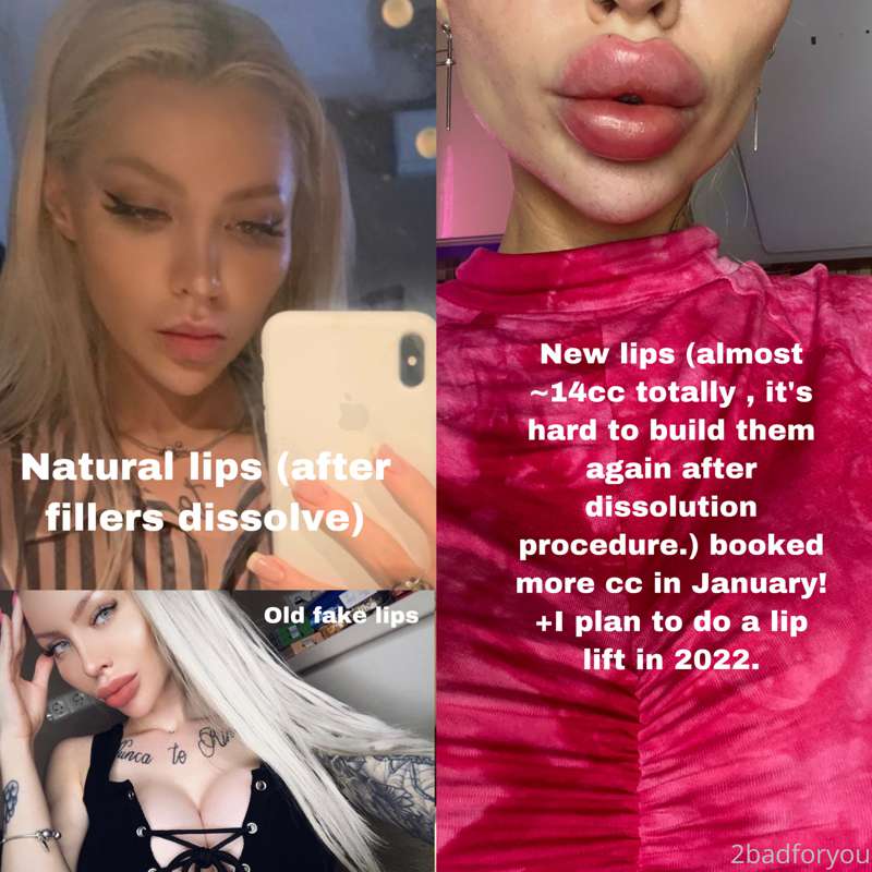💉lip progress💉
Just want to talk a little bit.
Yes, some guy..