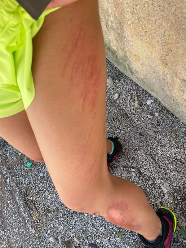 **NSFW** post-biking accident, ***who wants to take me to th.. 2