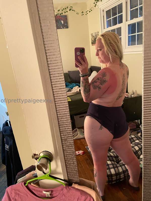 This sunburn 😩😩 3