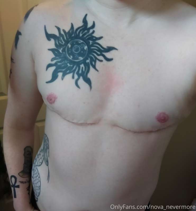 Top surgery update!