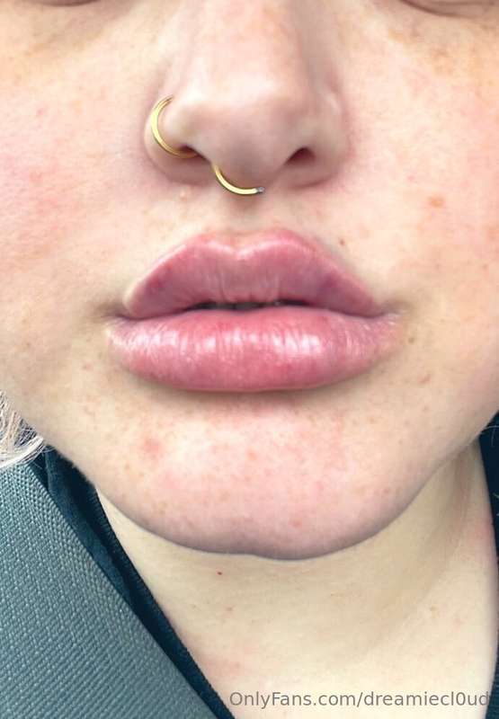 Ough a lil video of me getting my lips plumped! First look 🌸.. 2