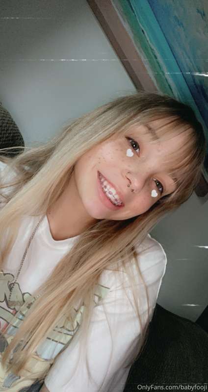 What do you think of my braces?!? ☺️ I’m so self conscious a.. 1