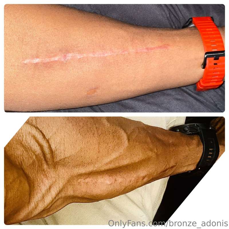 1 year ago I broke my left arm, and left wrist in an acciden.. 3