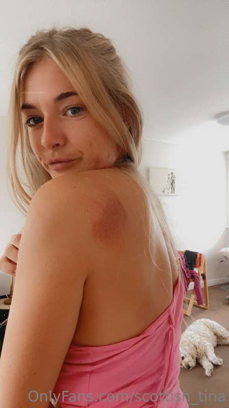I need a minder - covered in scars, bumps and bruises rn 😭  .. 2