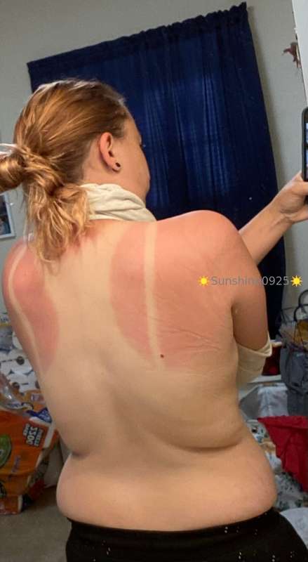 Yikes I got burned good yesterday 🥺 who wants to rub me down..