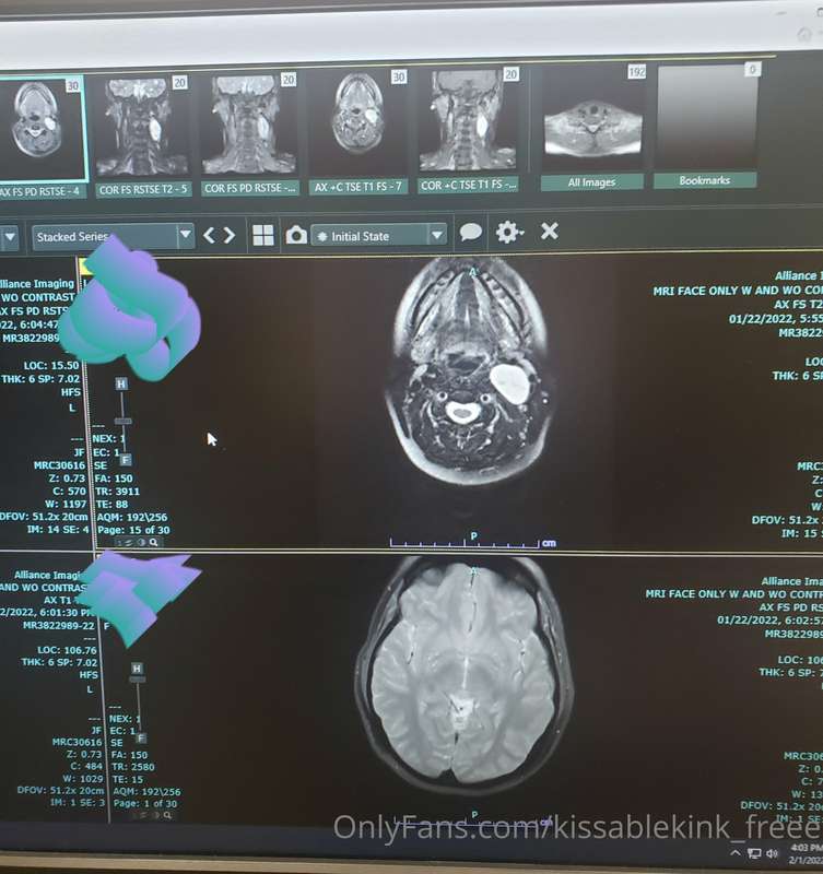 Got to see my scans yesterday. My tumor is the big white mas..